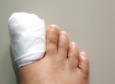 a-toe-in-a-bandage-recovering-from-ingrown-toenail-surgery (1)